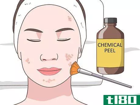 Image titled Get Rid of Acne Cysts Fast Step 20