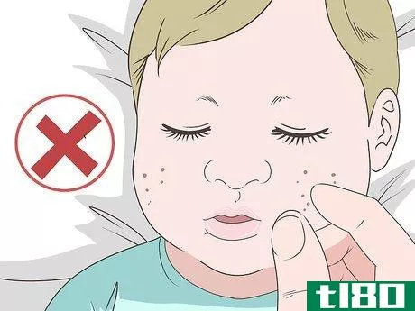 Image titled Get Rid of Baby Acne Step 4