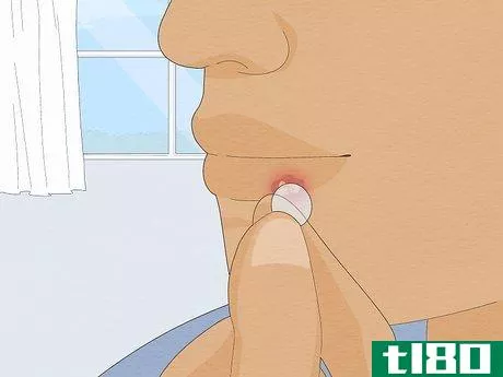 Image titled Get Rid of a Cold Sore Fast Step 3
