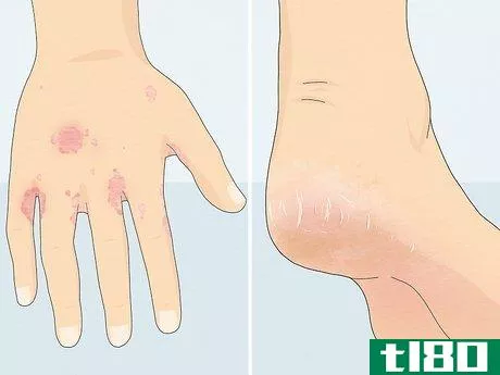 Image titled Heal Cracked Skin Step 1