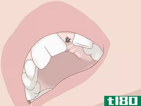 Image titled Know What to Expect when Getting a Tooth Implant Step 14