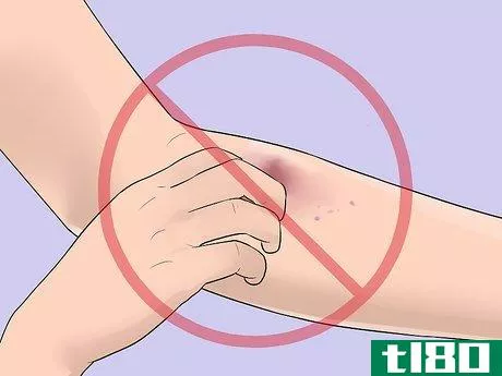 Image titled Know when Your Vein Has Collapsed Step 3