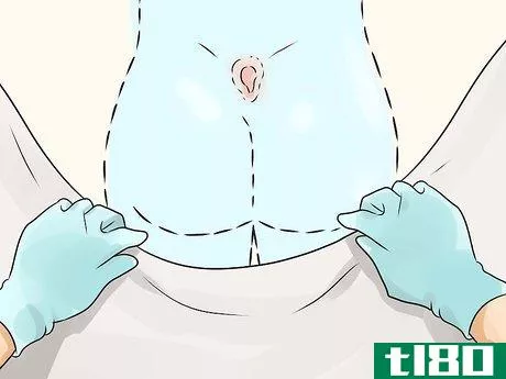 Image titled Get Rid of a Cyst Step 13