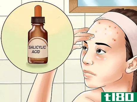 Image titled Get Rid of Forehead Acne Step 2