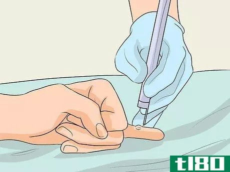 Image titled Get Rid of Warts on Fingers Step 5