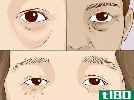 Image titled Improve Under Eye Skin Step 17.jpeg
