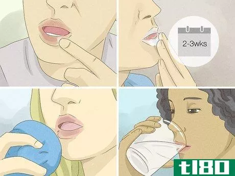 Image titled Heal Lips After Biting Them Step 17