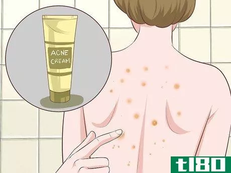 Image titled Get Rid of Back Acne Fast Step 3