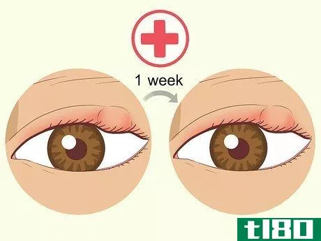 Image titled Get Rid of Puffy Eyelids Step 12