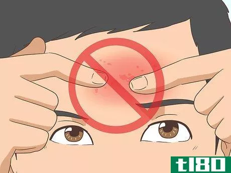 Image titled Get Rid of Acne Cysts Fast Step 12