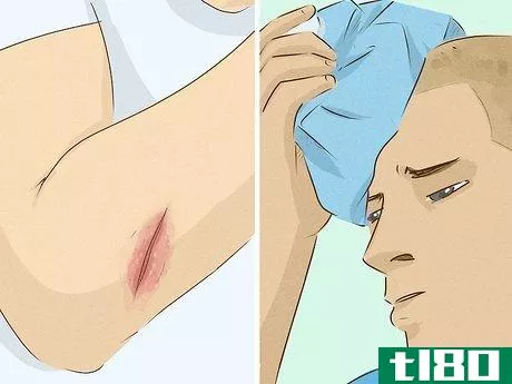 Image titled Heal Cuts Quickly (Using Easy, Natural Items) Step 19