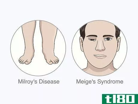 Image titled Identify Lymphedema Step 9