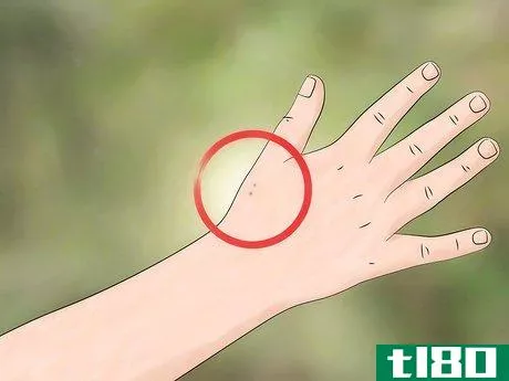 Image titled Identify and Treat Black Widow Spider Bites Step 1