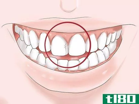 Image titled Know if Your Dental Fillings Need Replacing Step 8