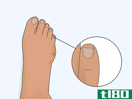Image titled Heal a Toe Injury Step 3