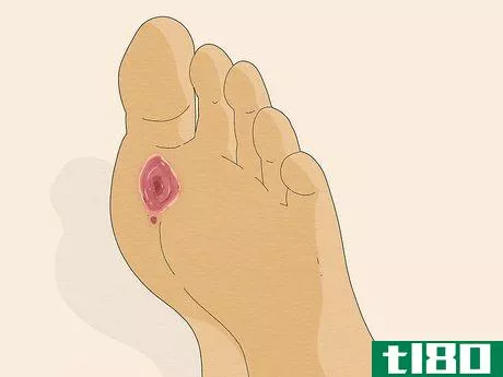 Image titled Know if You Have Neuropathy in Your Feet Step 5