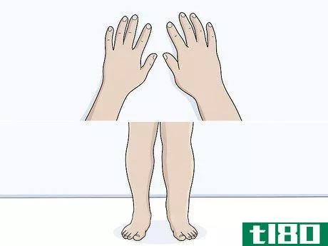 Image titled Identify Lymphedema Step 2