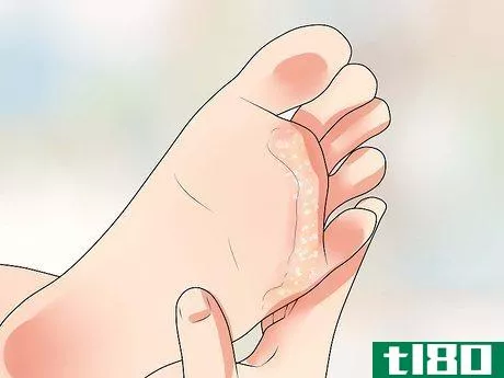 Image titled Know if You Have Athlete's Foot Step 2