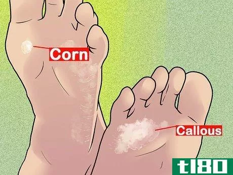 Image titled Know if You Have Corns Step 2