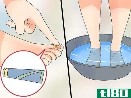 Image titled Know if You Have Nail Fungus Step 11