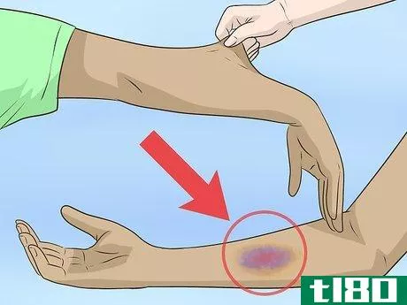 Image titled Know if You're Double Jointed Step 10