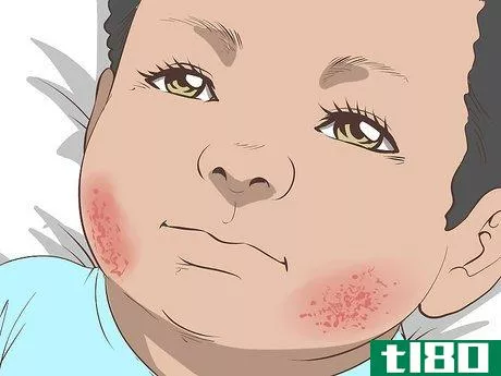 Image titled Identify and Treat Different Types of Diaper Rash Step 6