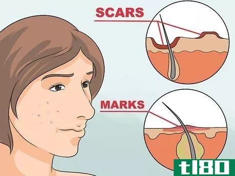 如何去除红色粉刺痕迹(get rid of red acne marks)