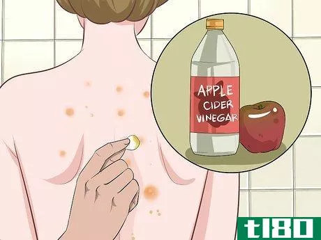 Image titled Get Rid of Back Acne Fast Step 8