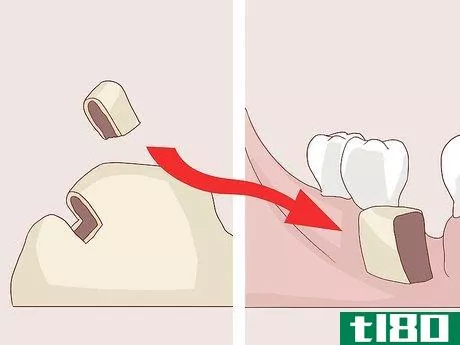 Image titled Know What to Expect when Getting a Tooth Implant Step 10