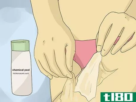 Image titled Get Rid of Stretch Marks Step 5