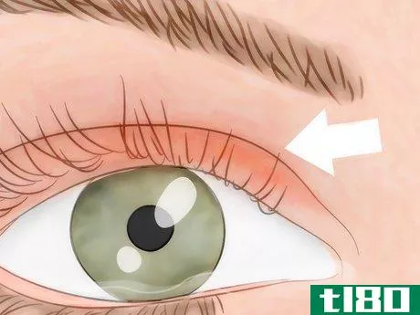 Image titled Know if You Have Eye Mites Step 3