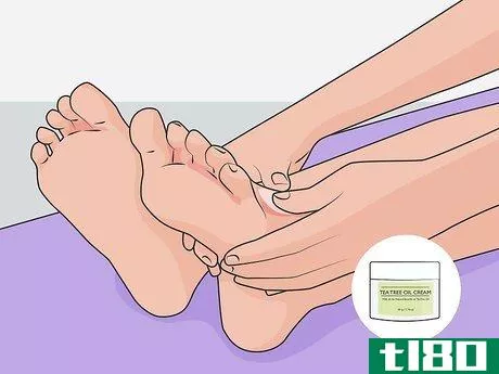 Image titled Get Rid of Foot Fungus at Home Step 06