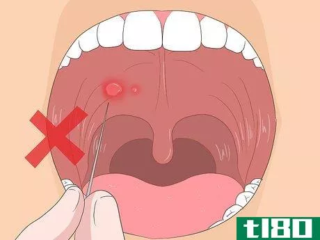 Image titled Get Rid of Mouth Blisters Step 16
