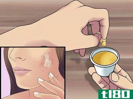 Image titled Get Rid of Cystic Acne Scars Step 4