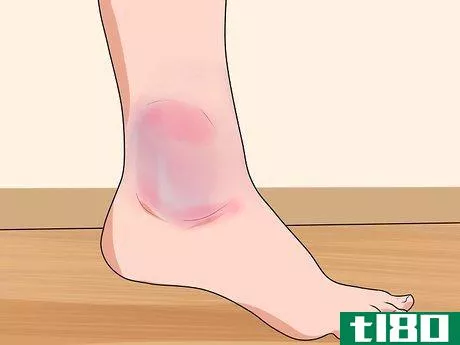 Image titled Know if You've Sprained Your Ankle Step 3