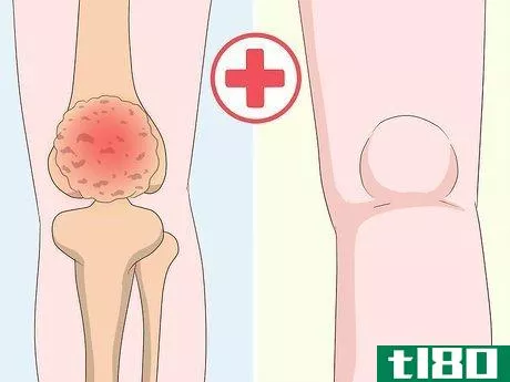 Image titled Get Rid of Leg Pain Step 15