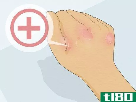 Image titled Heal Cracked Skin Step 20