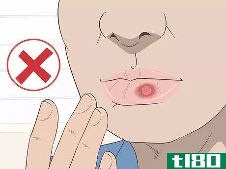 Image titled Get Rid of a Cold Sore with Home Remedies Step 11