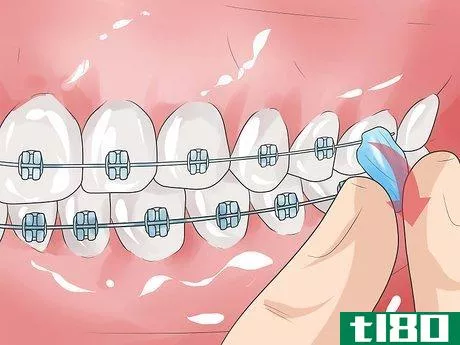 Image titled Handle Poking Wires on Braces Step 5
