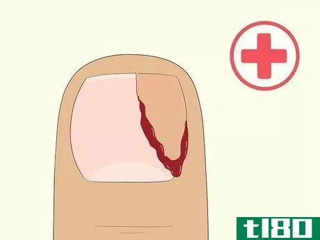Image titled Heal Damaged Nails Step 5