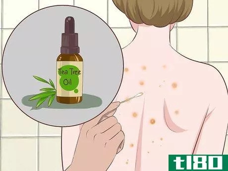 Image titled Get Rid of Back Acne Fast Step 7