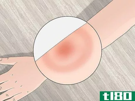 Image titled Identify Tick Bites Step 7
