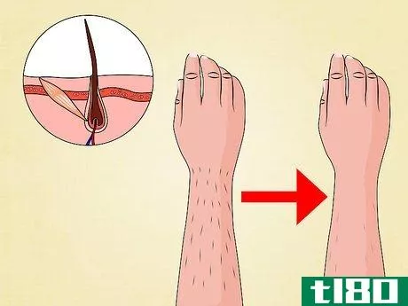 Image titled Get the Most Benefit from Laser Hair Removal Step 11