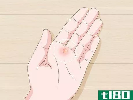 Image titled Heal Blisters Step 1