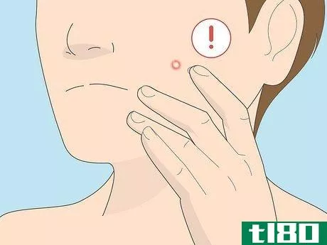 Image titled Get Rid of a Pimple Using Toothpaste Step 6