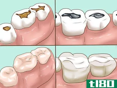 Image titled Know if Your Dental Fillings Need Replacing Step 10