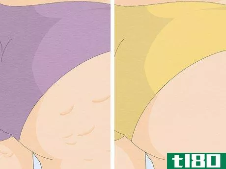 Image titled Get Rid of Cellulite With Exercise Step 1