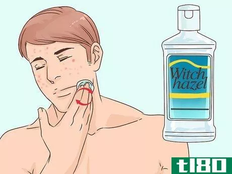 Image titled Get Rid of a Popped Pimple Overnight Step 10