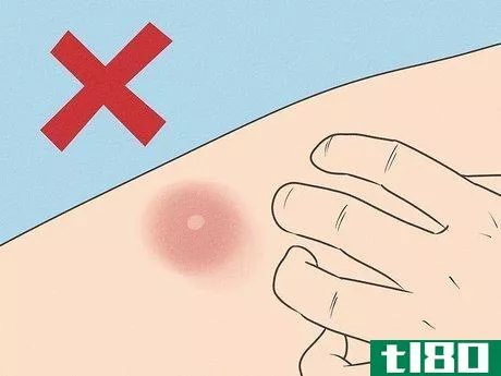 Image titled Get Rid of a Mosquito Bite Step 1