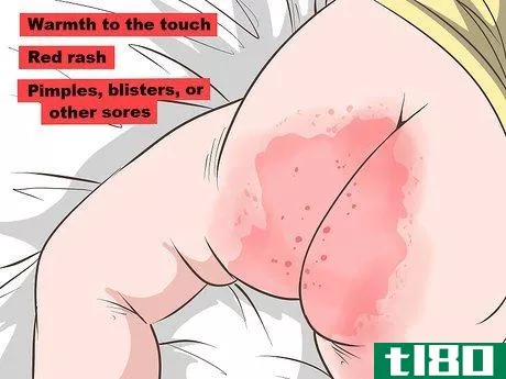 Image titled Identify and Treat Different Types of Diaper Rash Step 1